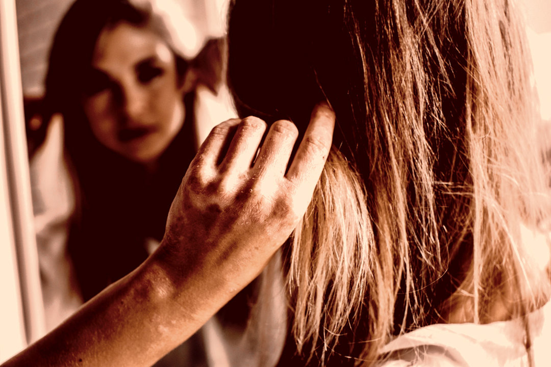 Woman with ulcers