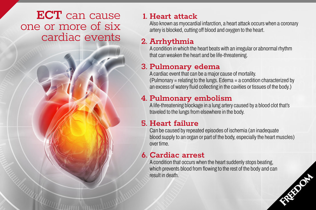 ECT leads to 6 cardiac events