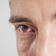 Bloodshot eyes
