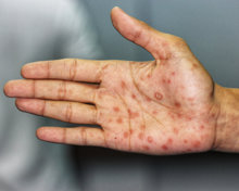Hand with syphilis