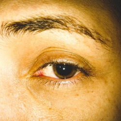 Woman with dialated pupils