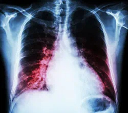 An xray of a human chest